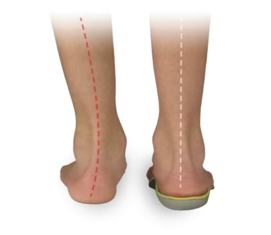 Orthopedic/ proactive insoles  iORTO DOUBLE KID_1388.jpg